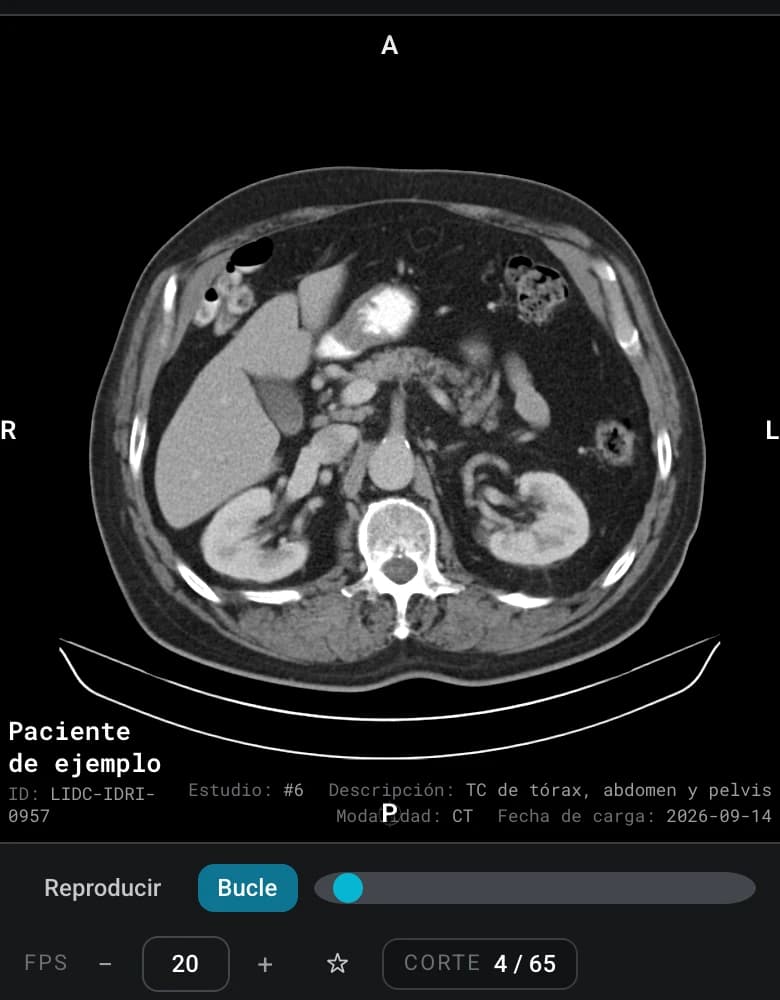 El visor de OrionViewer en un teléfono: un corte axial de abdomen con los controles de reproducción y el número de corte.