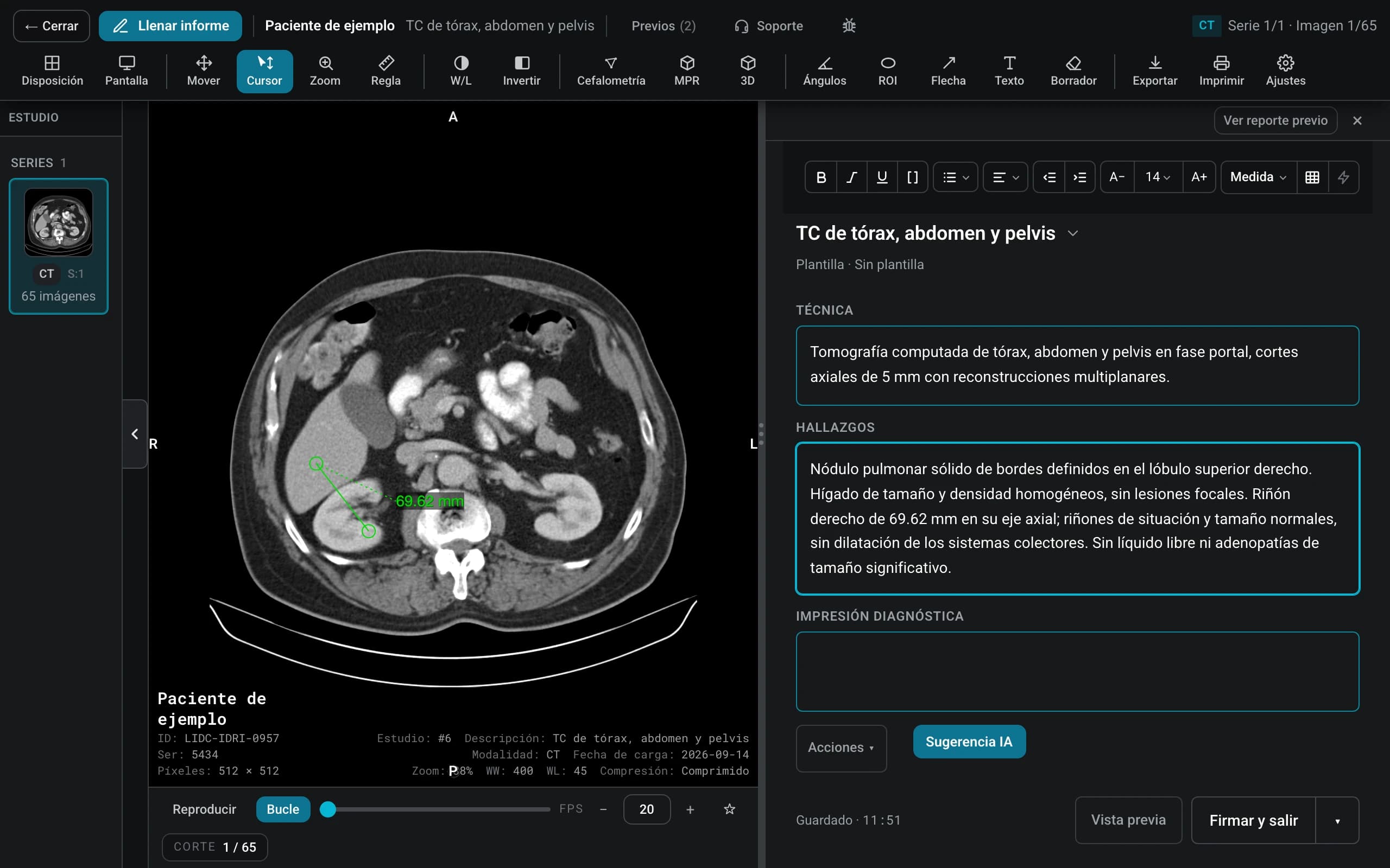 El visor de OrionViewer con una tomografía de abdomen y una regla sobre el riñón derecho; a la derecha, el informe con la técnica y los hallazgos escritos y la impresión por dictar.