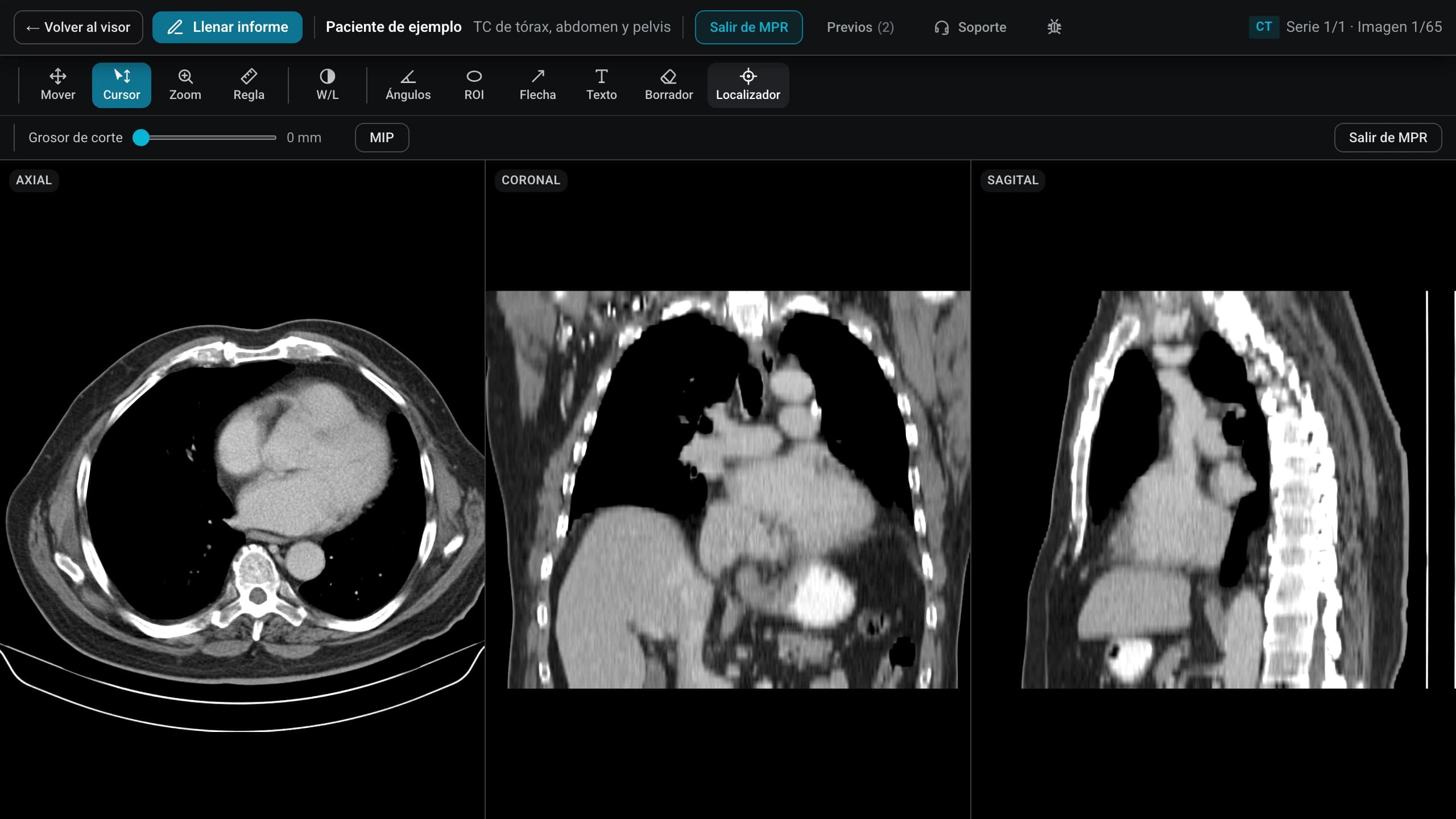 Reconstrucción multiplanar en el visor: el mismo estudio de tomografía en los planos axial, coronal y sagital, con la barra de herramientas y el grosor de corte.